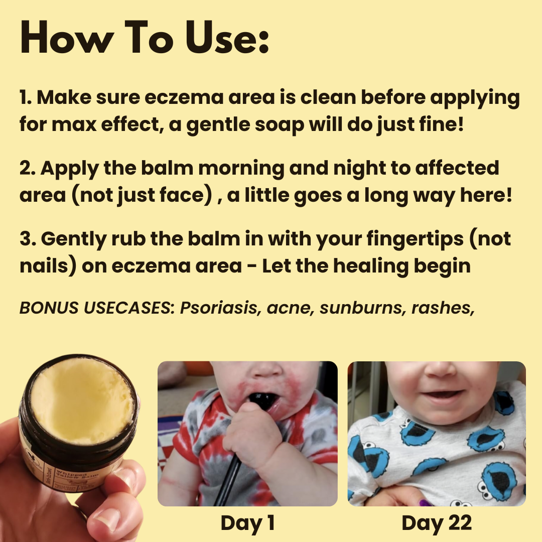 Eczema Whipped Tallow & Honey Balm